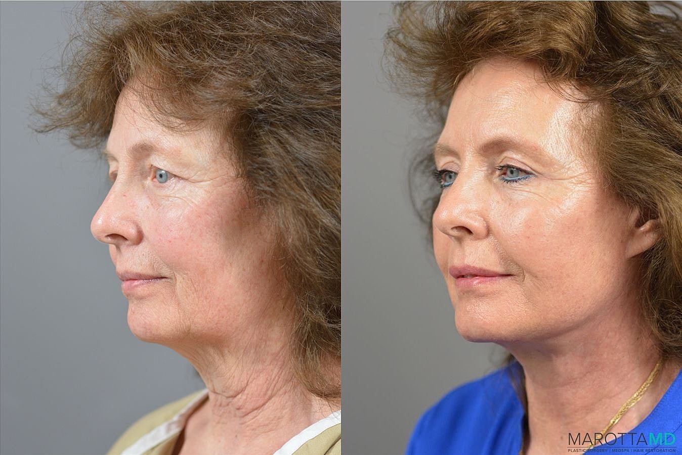 Facelift Before & After