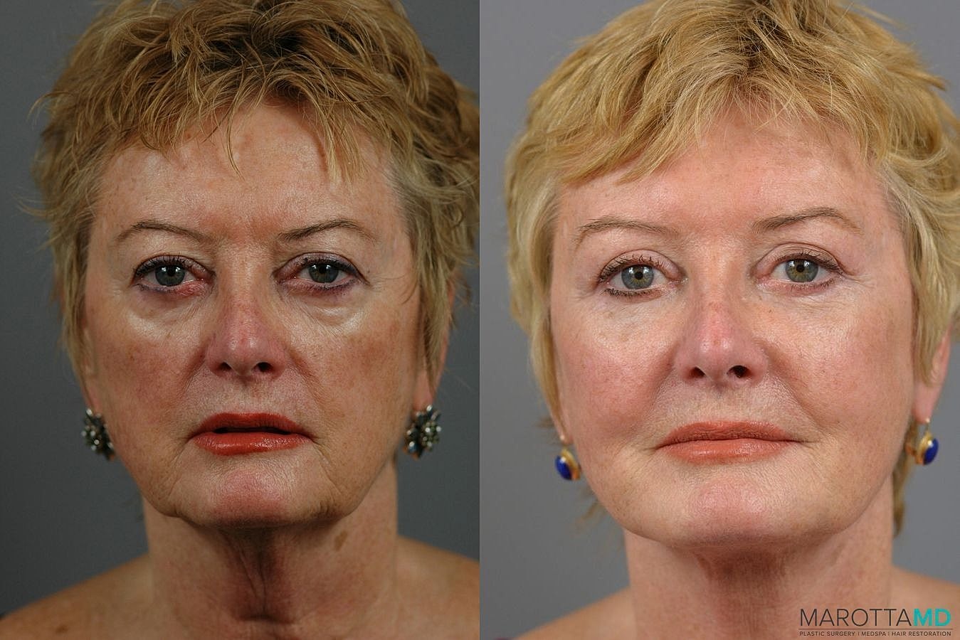 Facial Fat Transfer Before & After