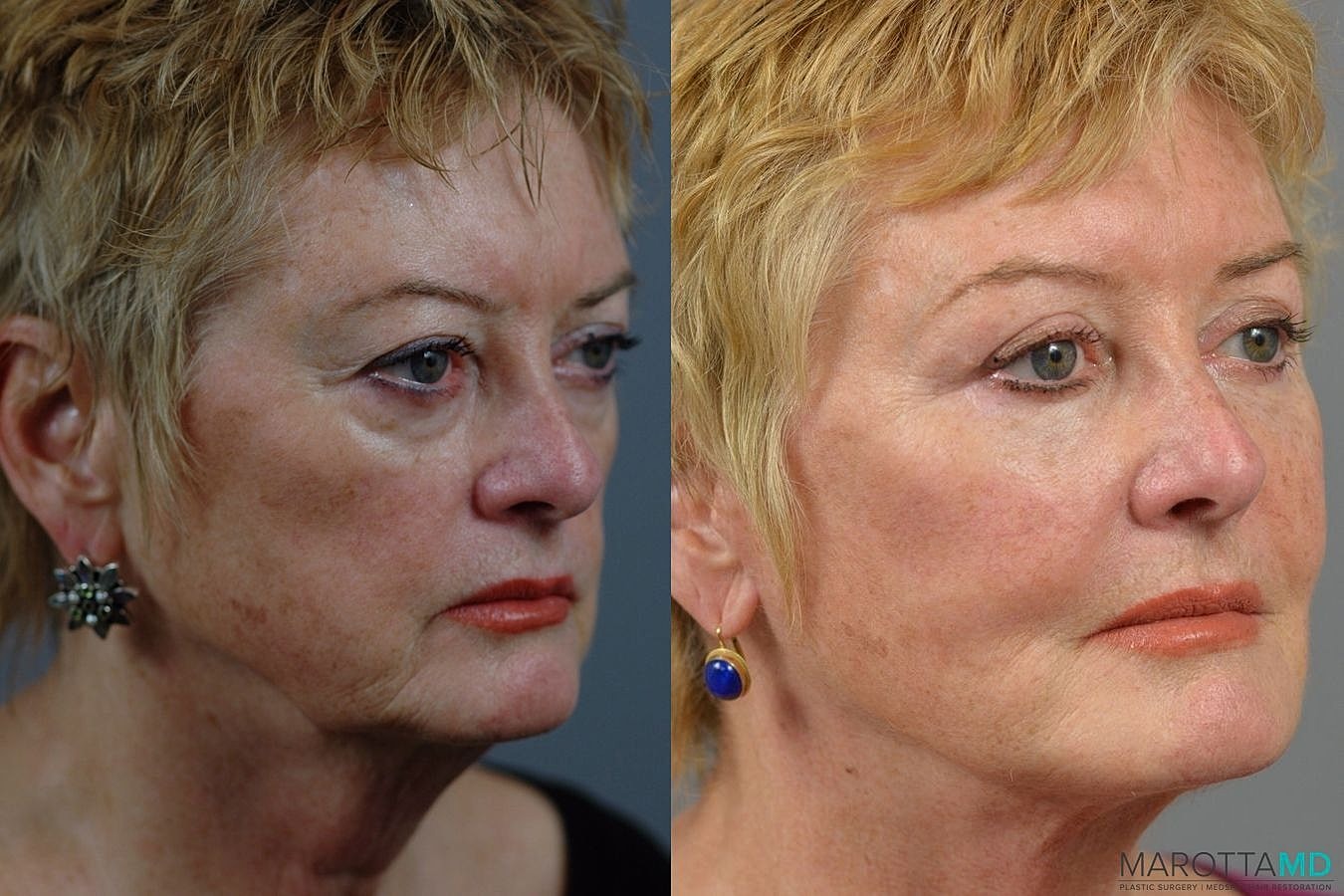 Facial Fat Transfer Before & After
