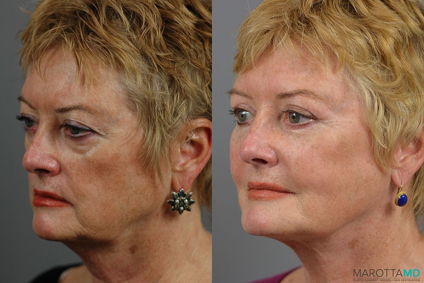 Facial Fat Transfer Before & After