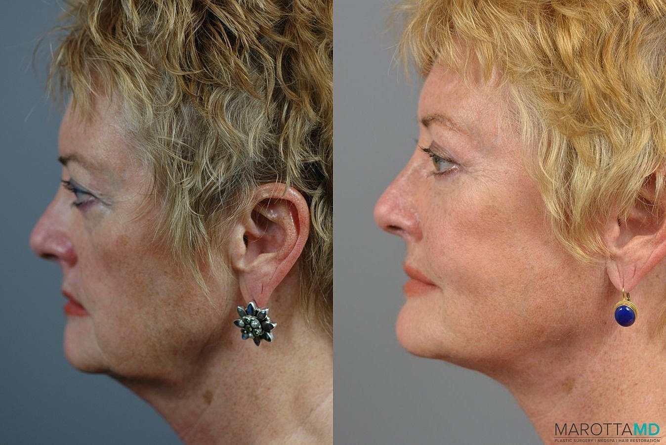 Facial Fat Transfer Before & After