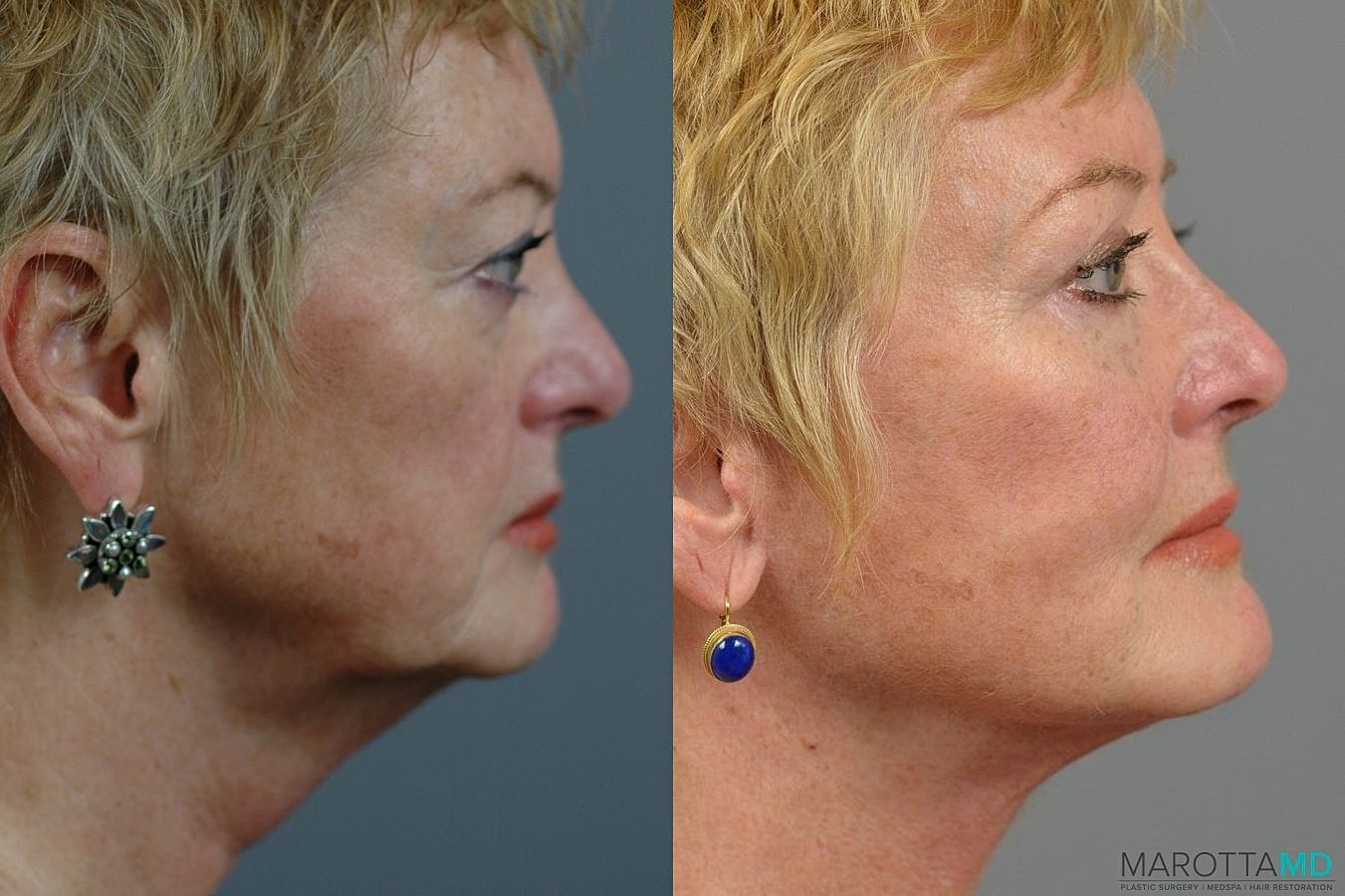 Facial Fat Transfer Before & After