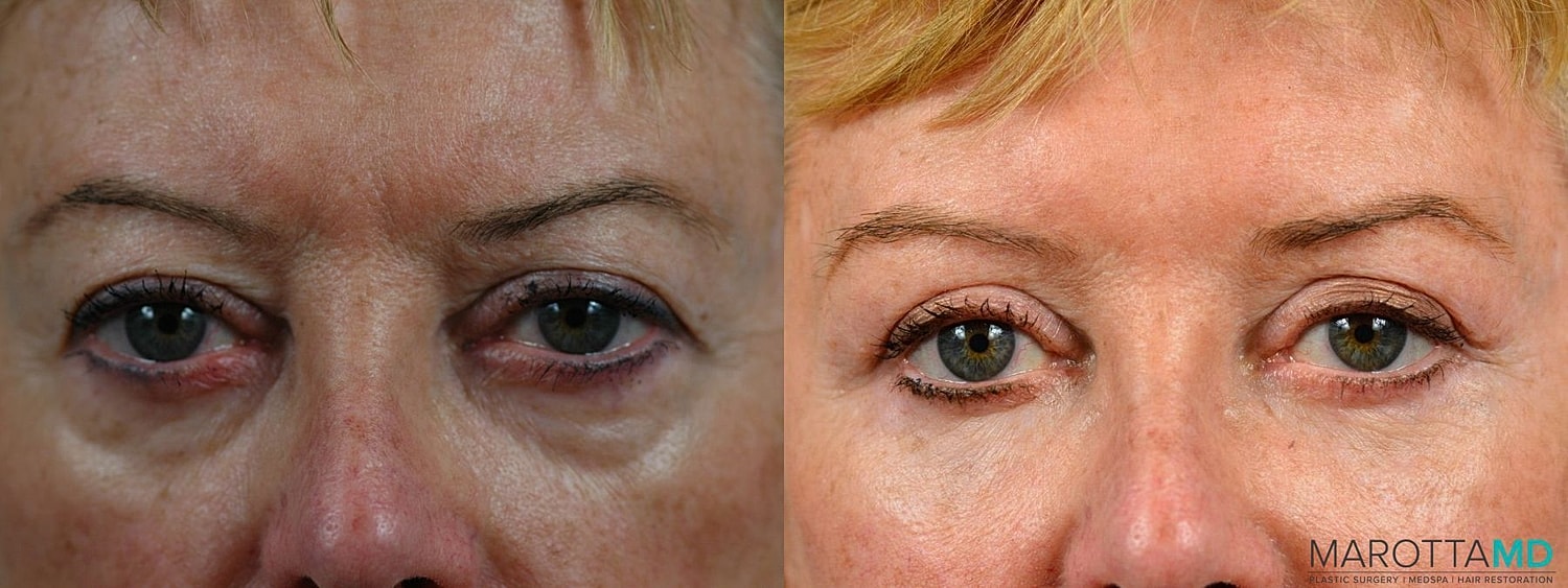 Facial Fat Transfer Before & After