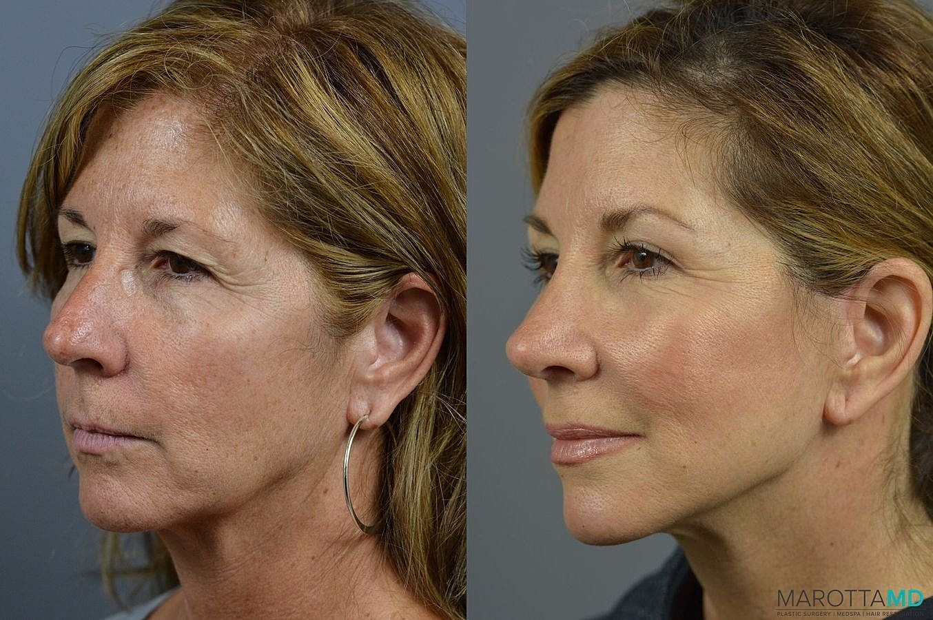 Facial Fat Transfer Before & After