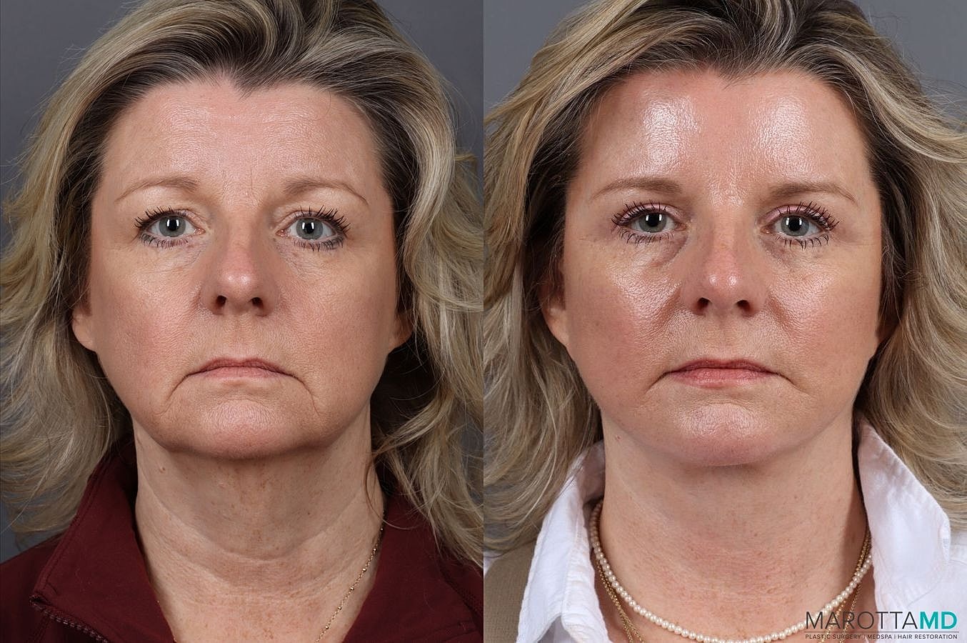 Facial Fat Transfer Before & After