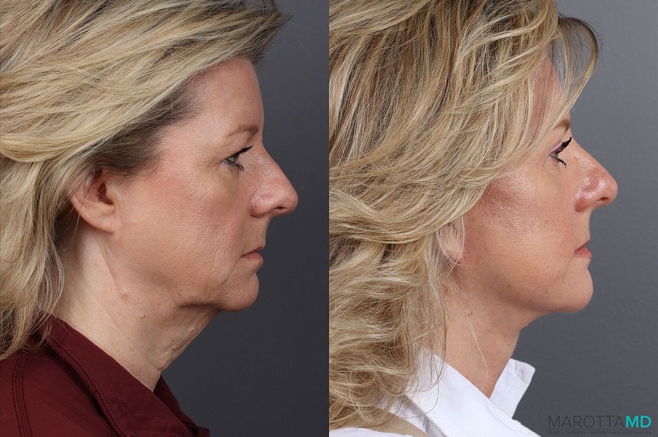 Facial Fat Transfer Before & After