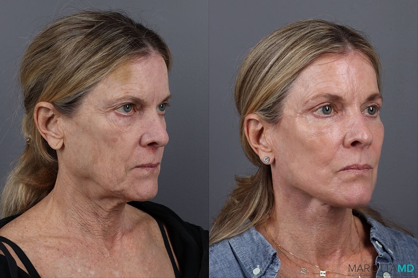 Facial Fat Transfer Before & After