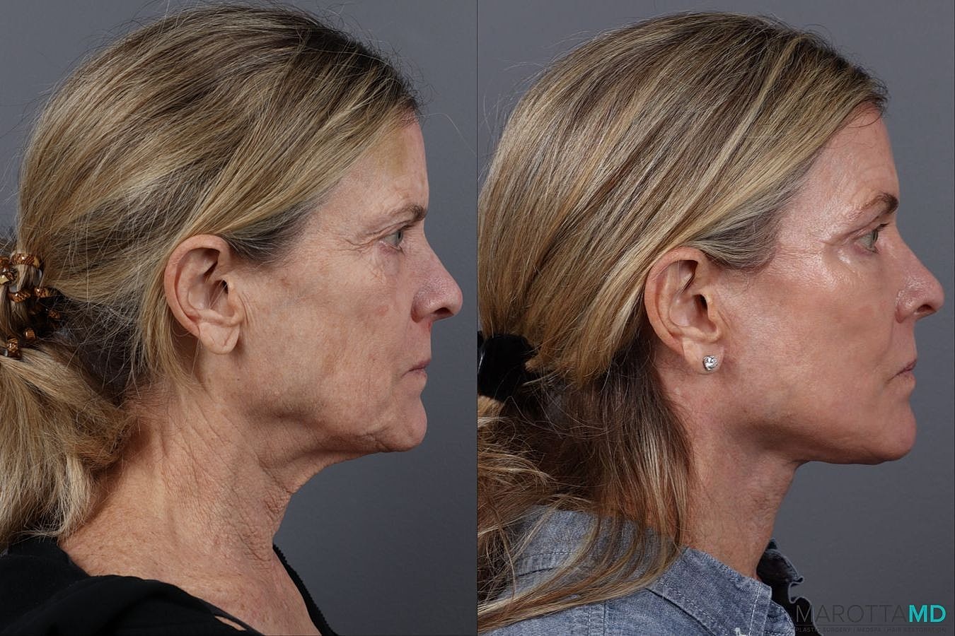 Facial Fat Transfer Before & After