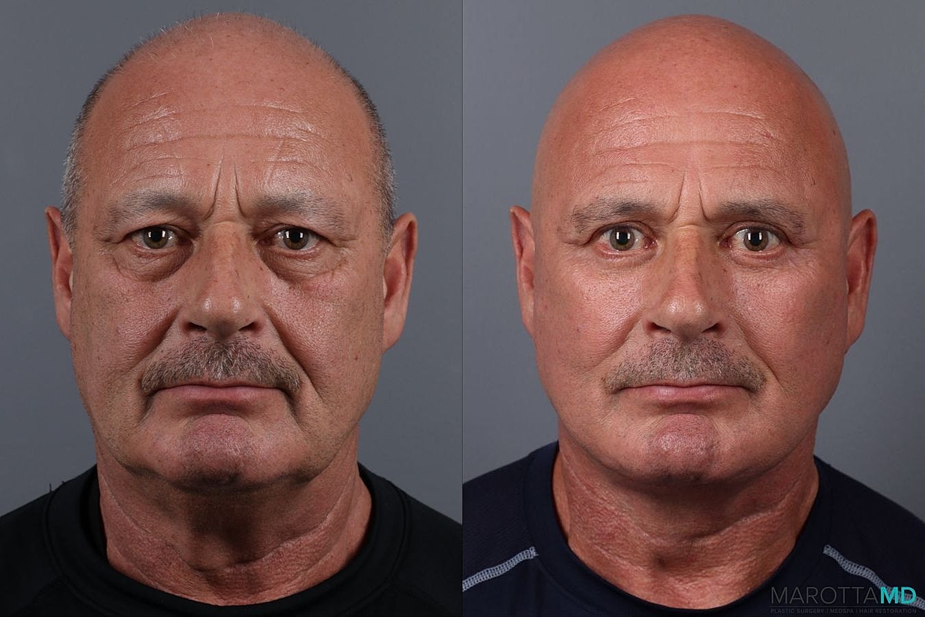 Facial Fat Transfer Before & After