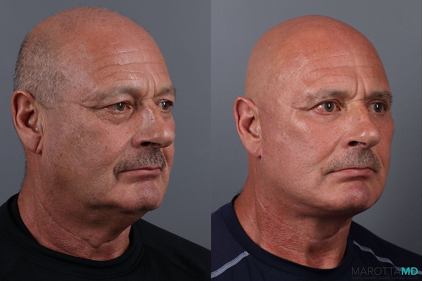 Facial Fat Transfer Before & After