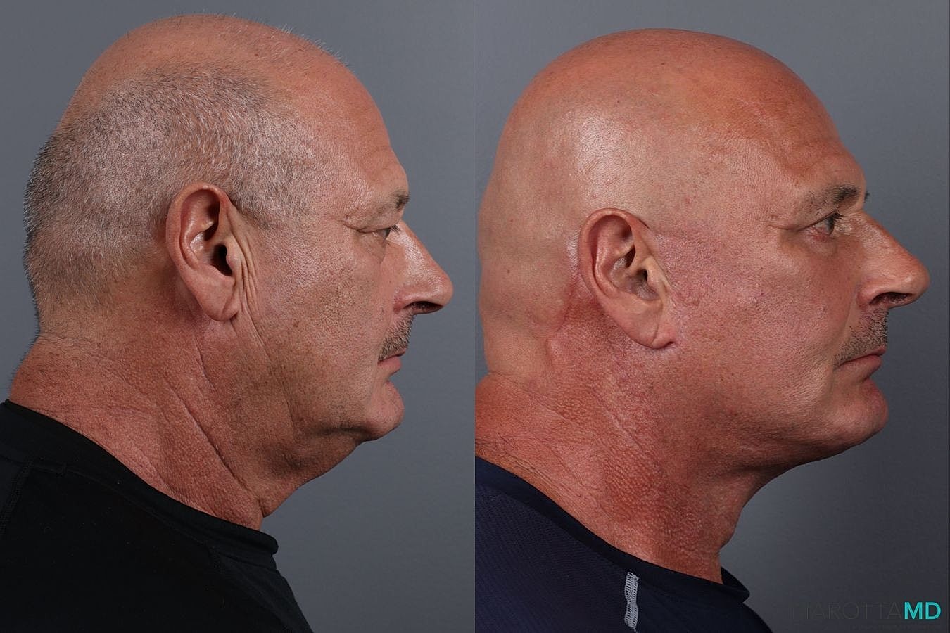 Facial Fat Transfer Before & After