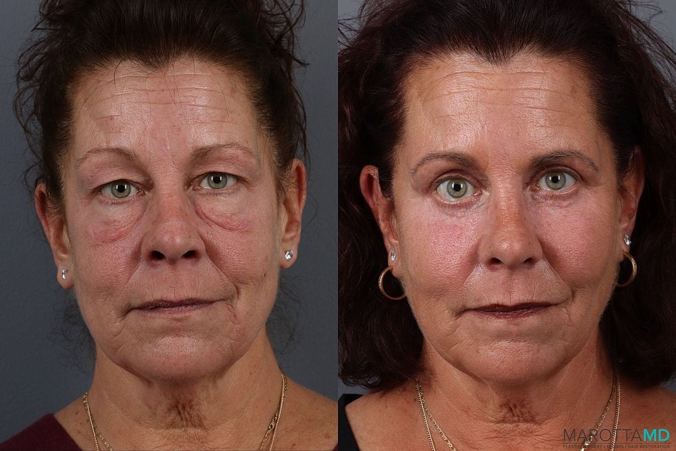 Facial Fat Transfer Before & After