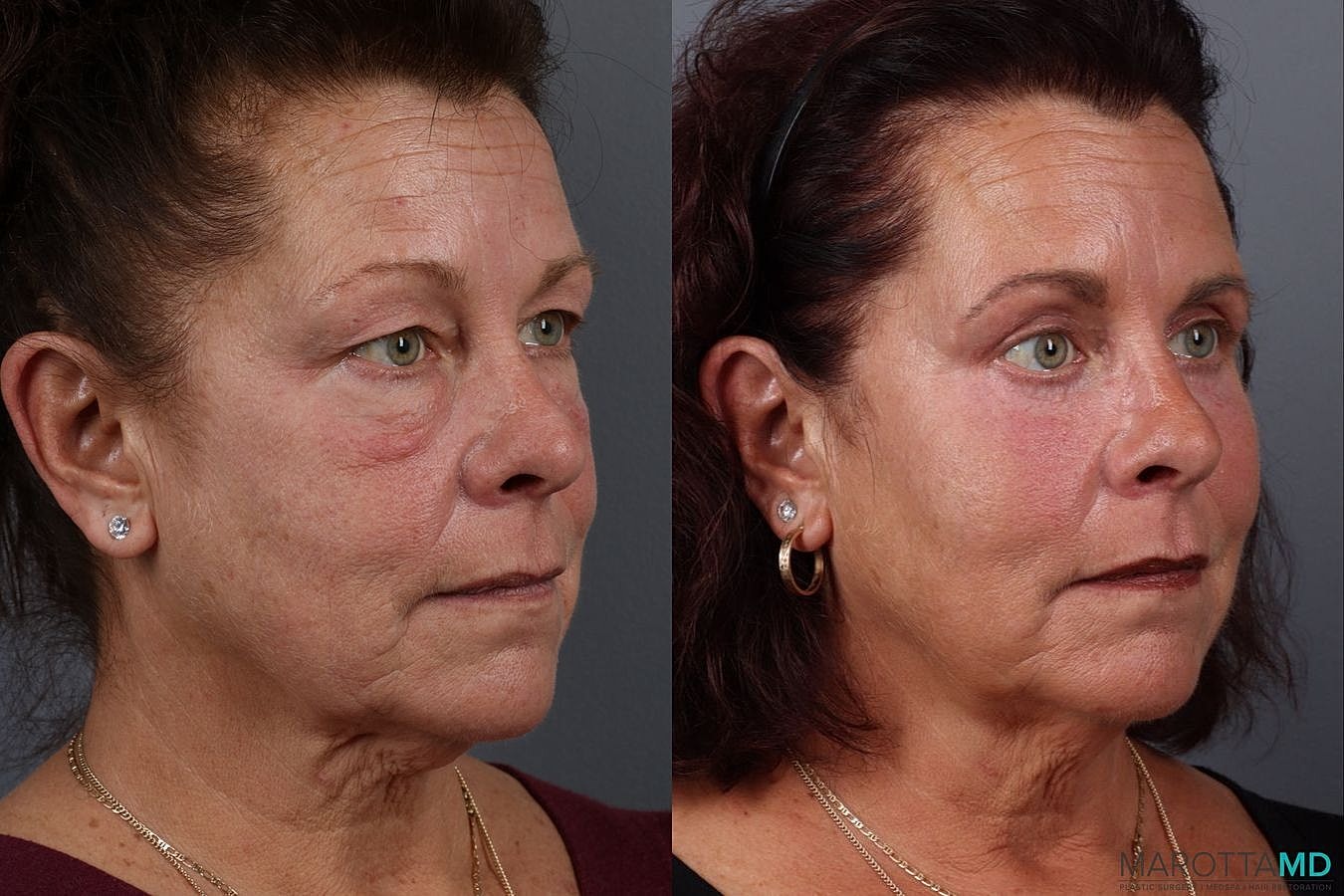 Facial Fat Transfer Before & After