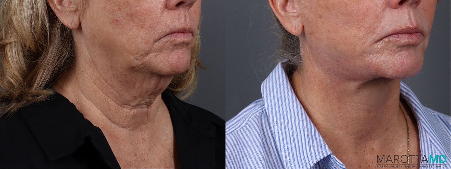 Facial Fat Transfer Before & After