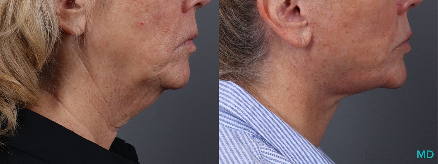 Facial Fat Transfer Before & After
