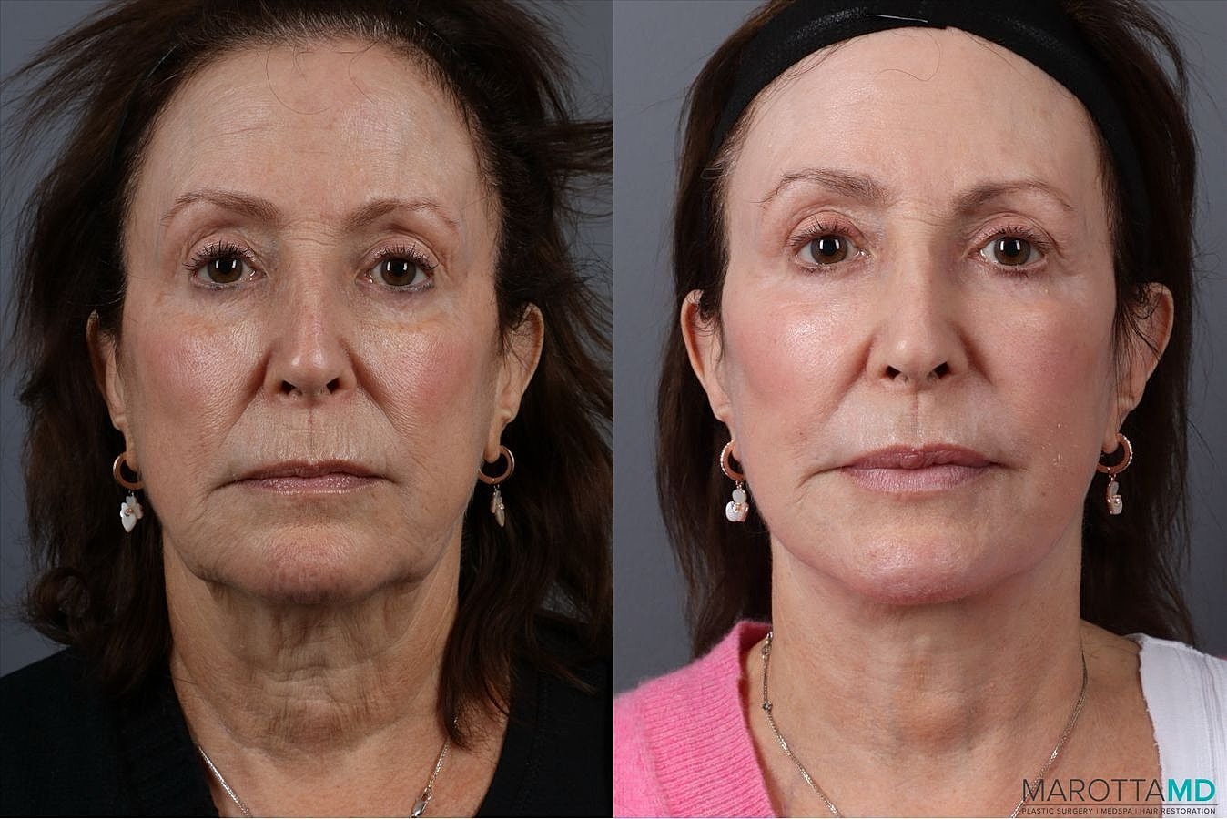 Facial Fat Transfer Before & After