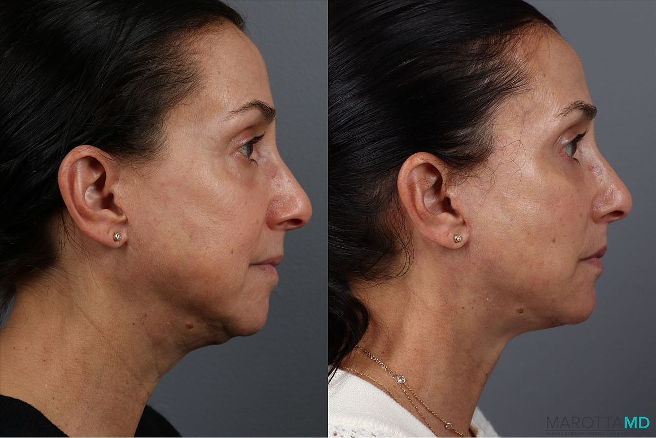 Facial Fat Transfer Before & After