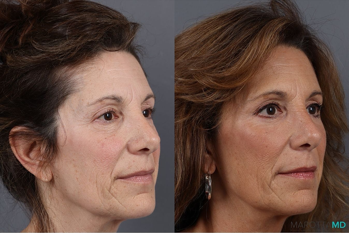 Facial Fat Transfer Before & After