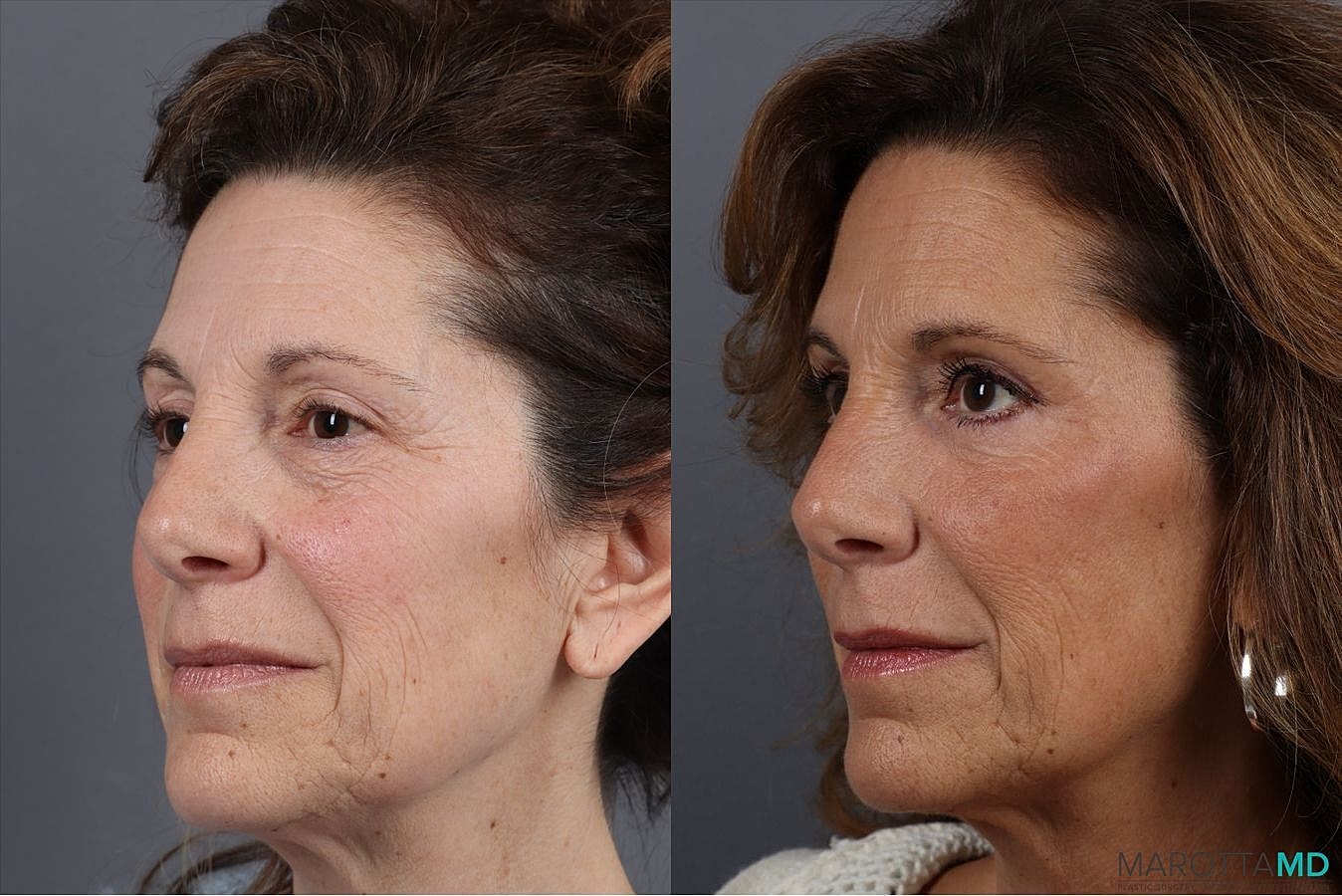 Facial Fat Transfer Before & After