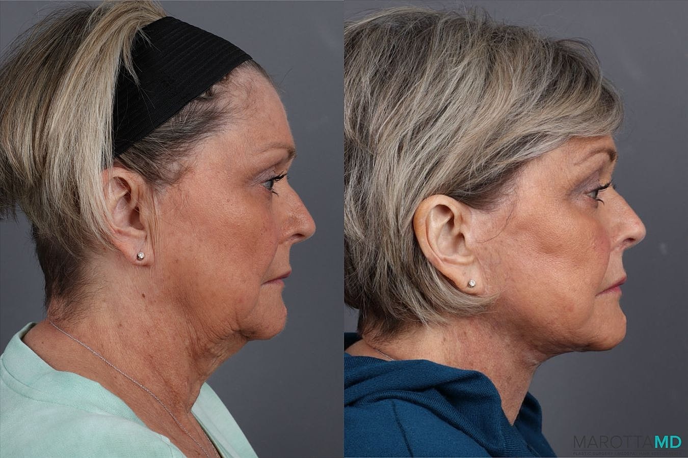 Facial Fat Transfer Before & After