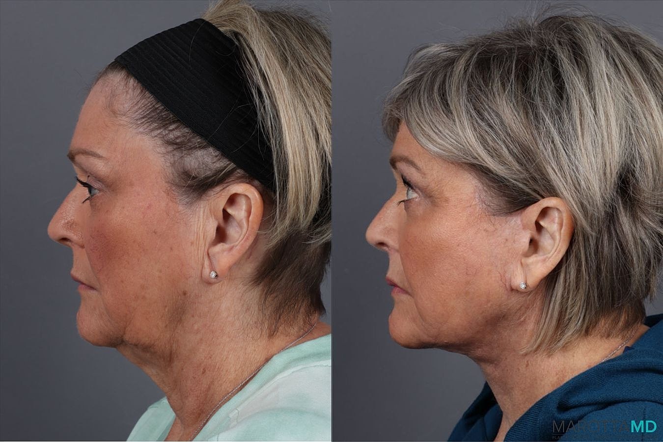 Facial Fat Transfer Before & After