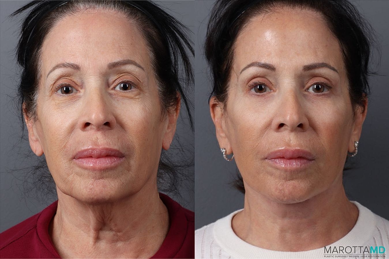 Facial Fat Transfer Before & After
