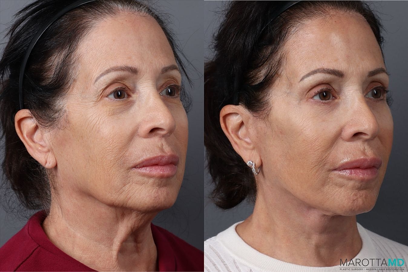 Facial Fat Transfer Before & After
