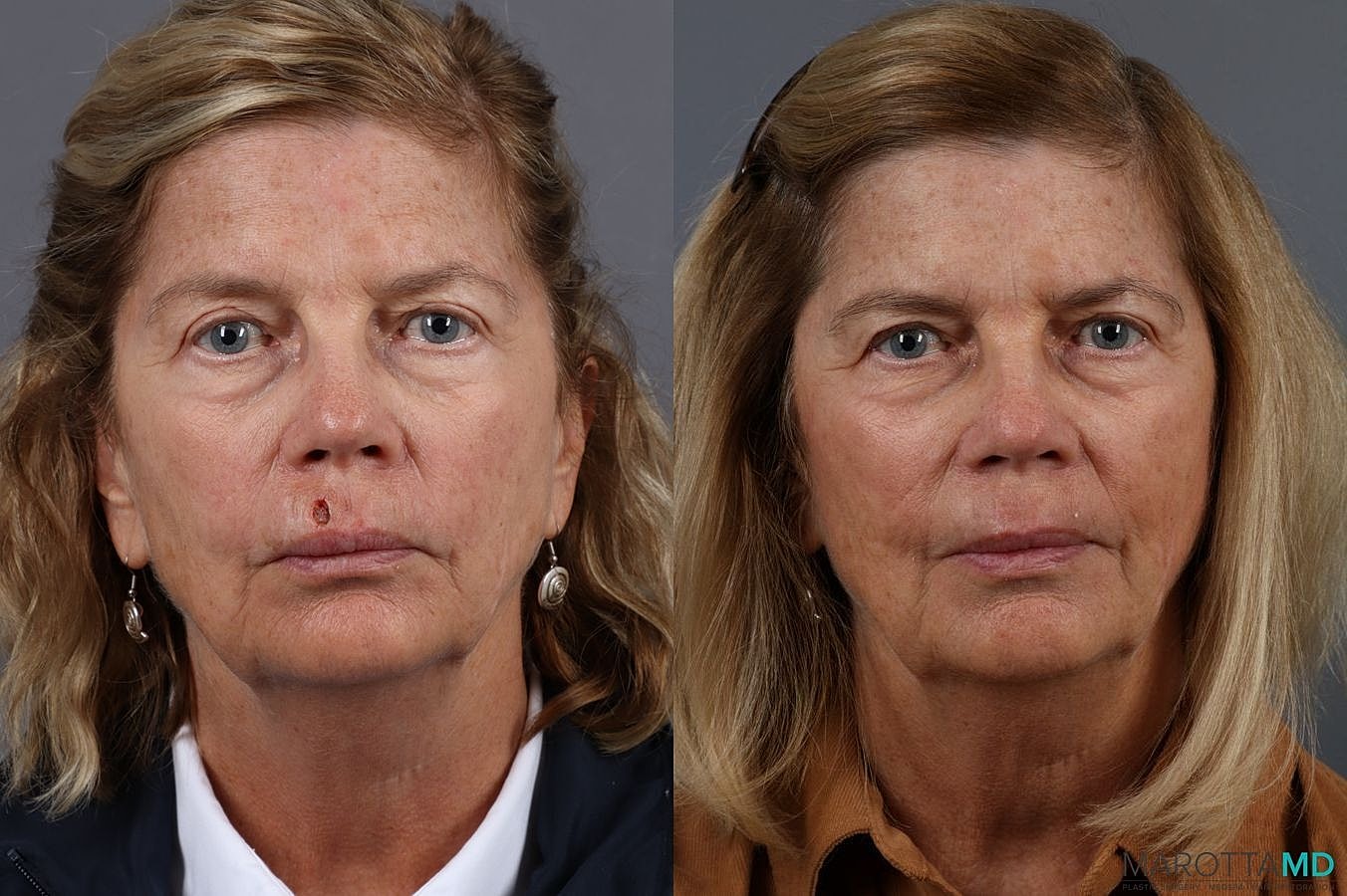 Skin Cancer Reconstruction Face Before & After
