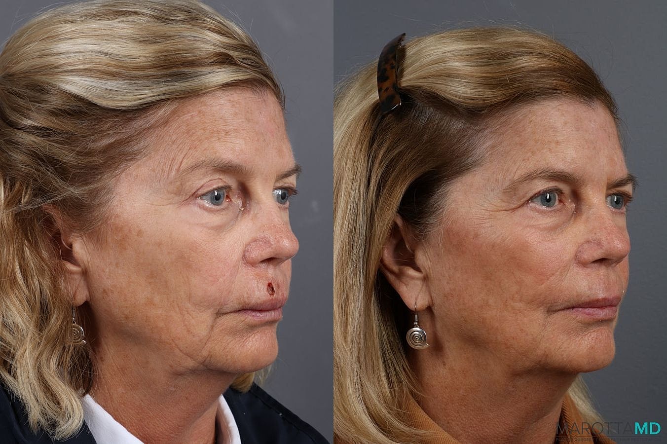 Skin Cancer Reconstruction Face Before & After