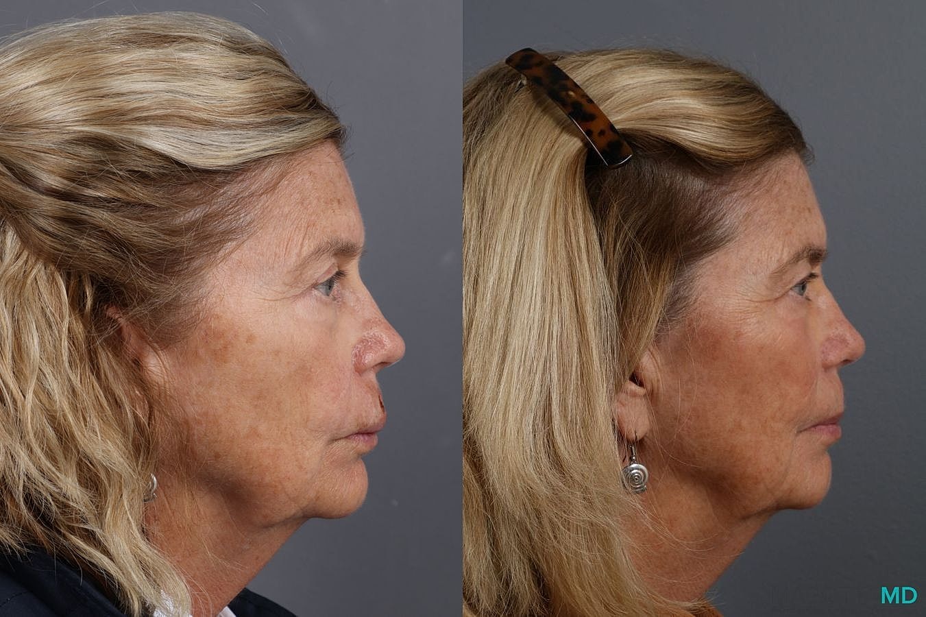 Skin Cancer Reconstruction Face Before & After