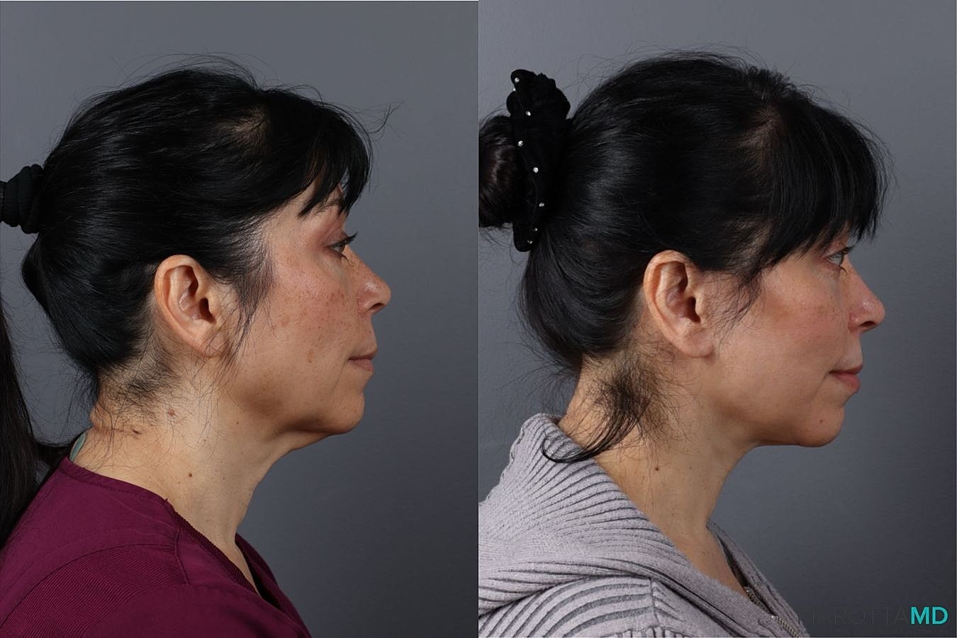 Neck Lift Before & After