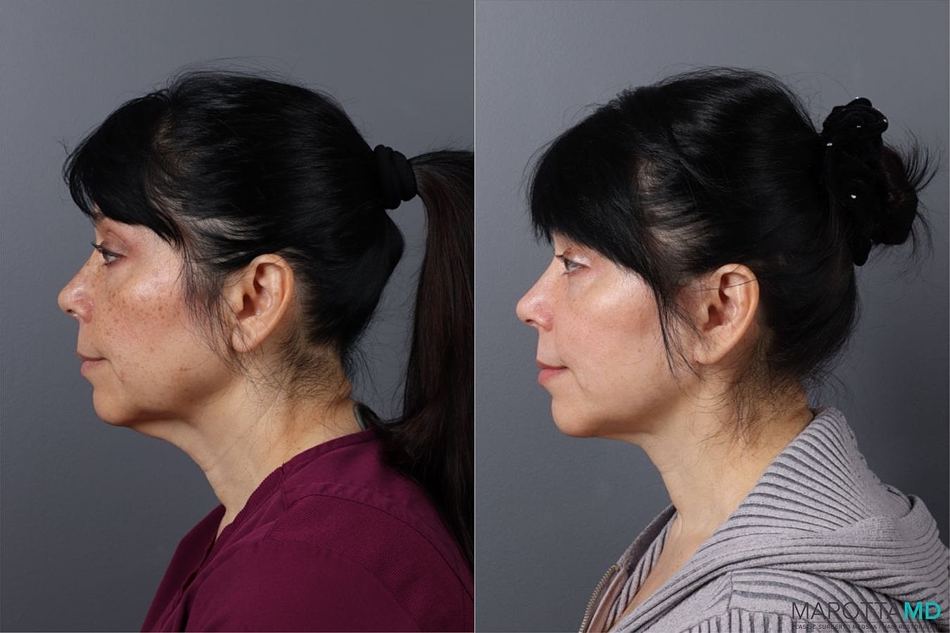 Neck Lift Before & After