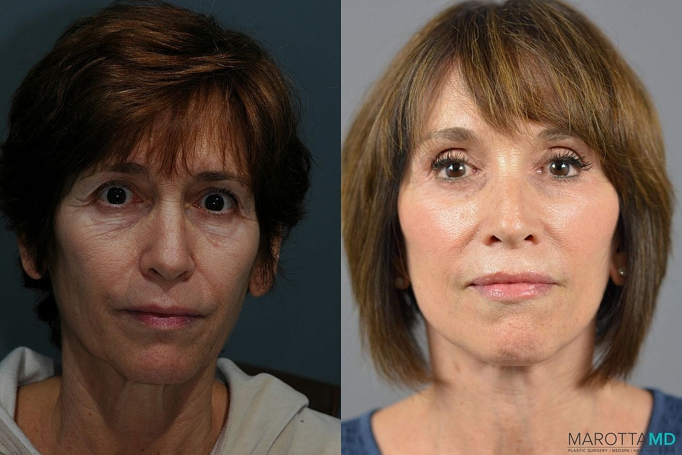 Facelift Neck Lift Before & After