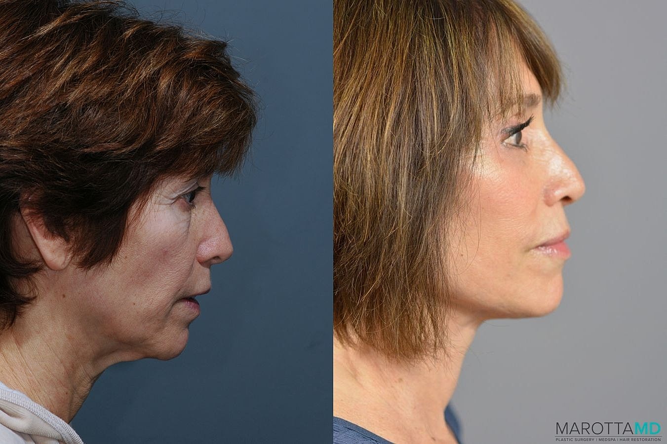 Facelift Neck Lift Before & After
