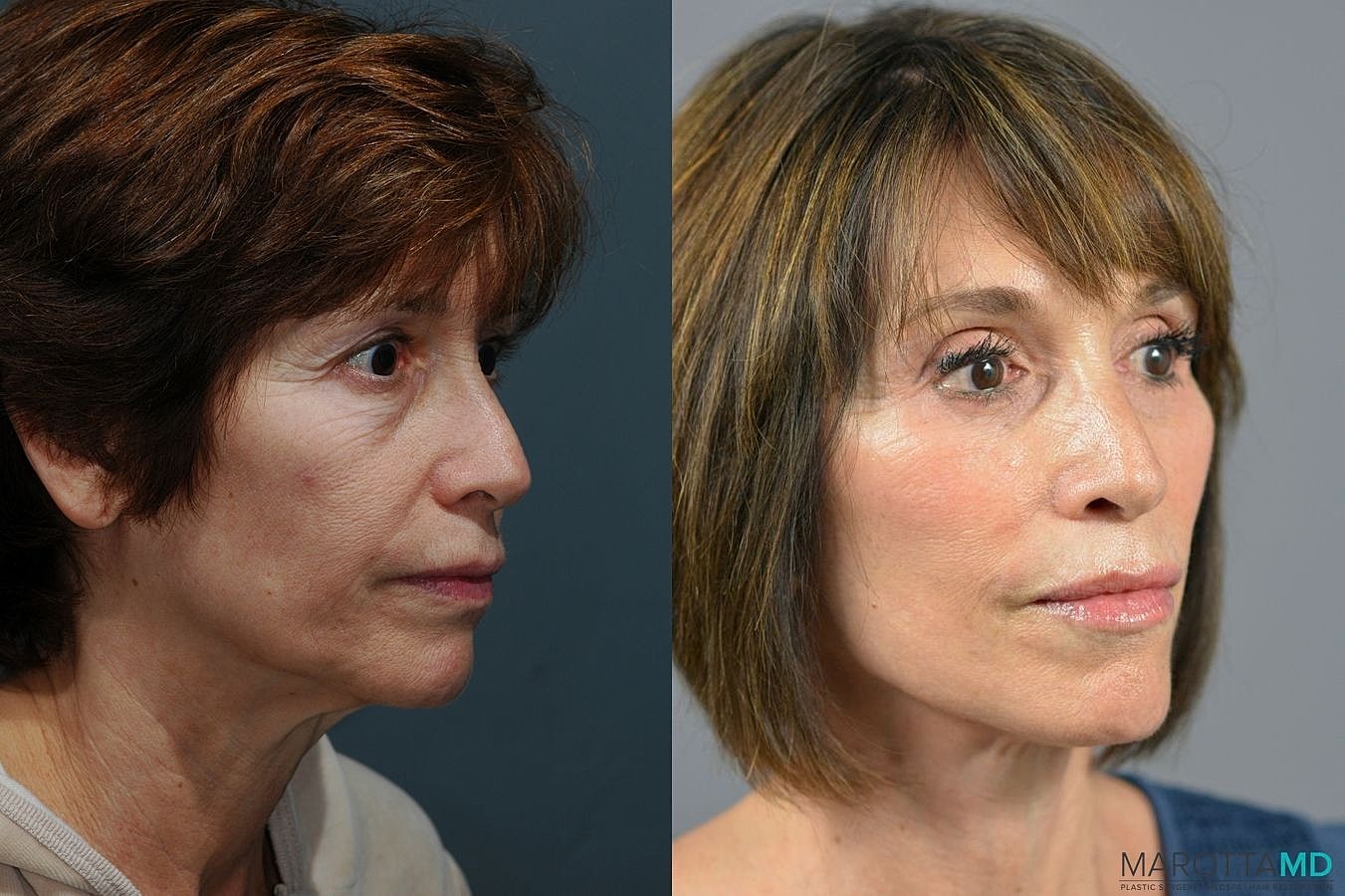 Facelift Neck Lift Before & After
