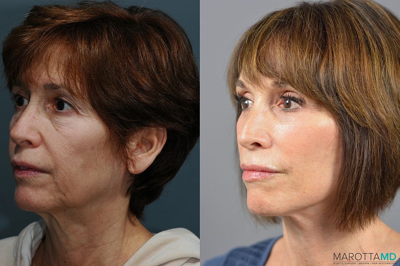 Facelift Neck Lift Before & After