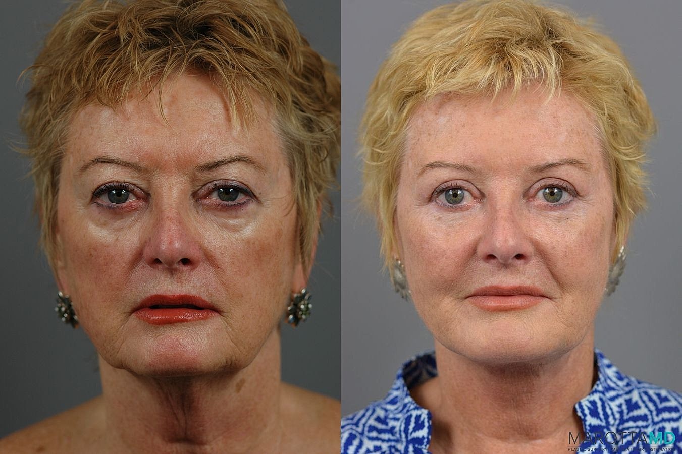 Facelift Neck Lift Before & After