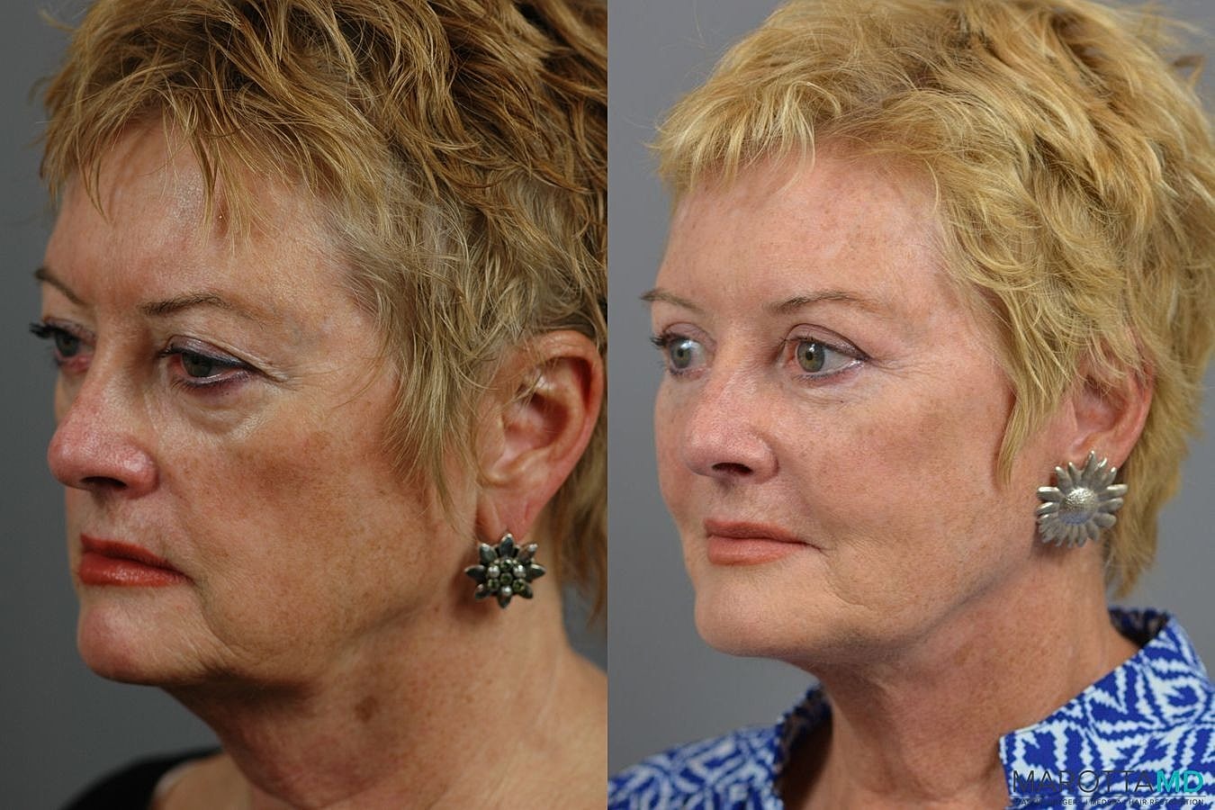Facelift Neck Lift Before & After
