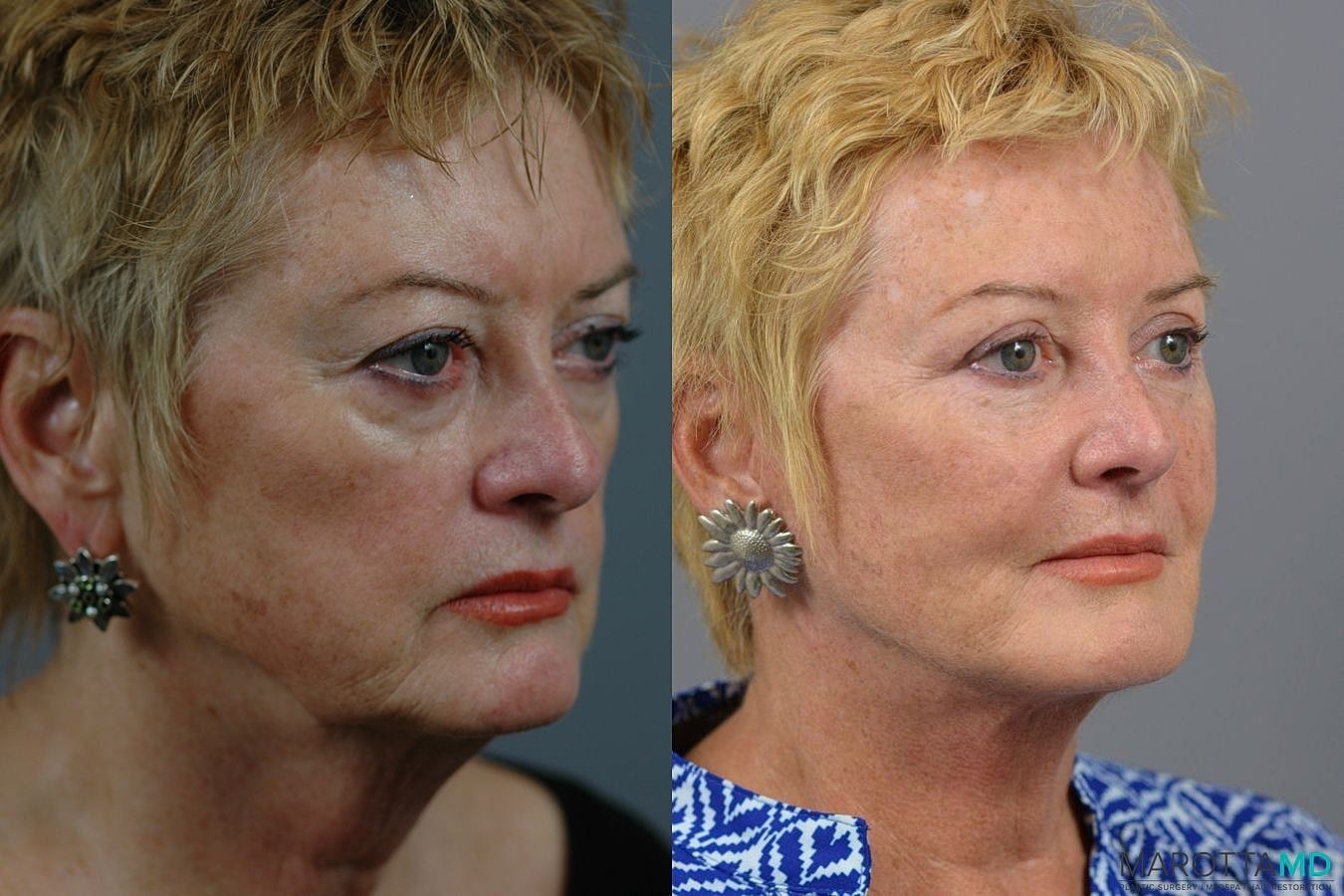 Facelift Neck Lift Before & After