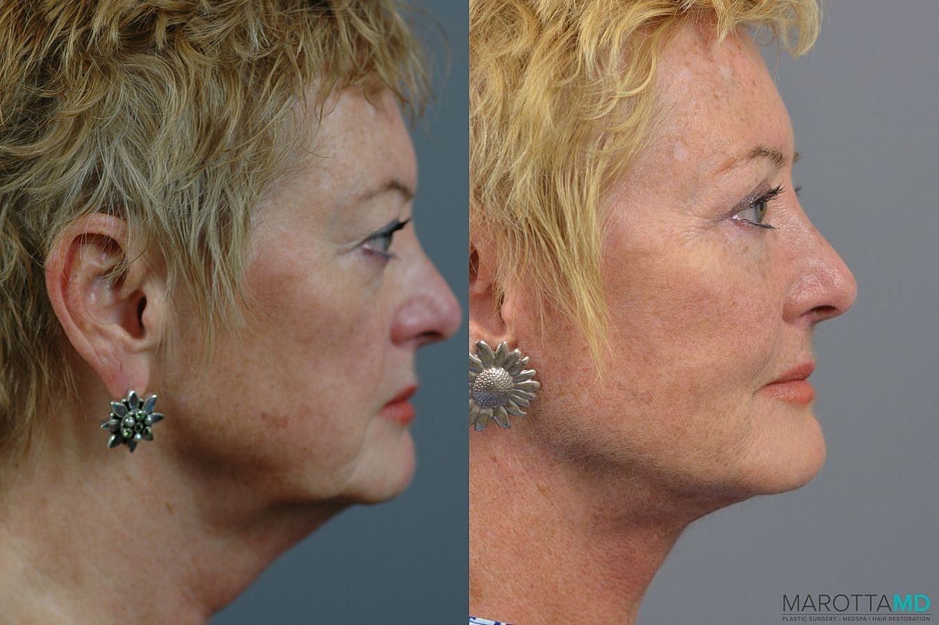 Facelift Neck Lift Before & After