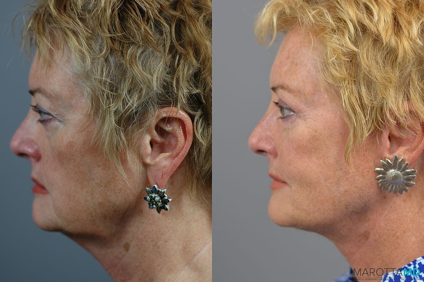 Facelift Neck Lift Before & After