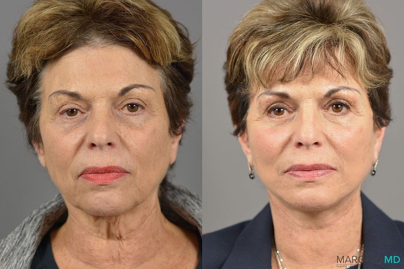 Facelift Neck Lift Before & After