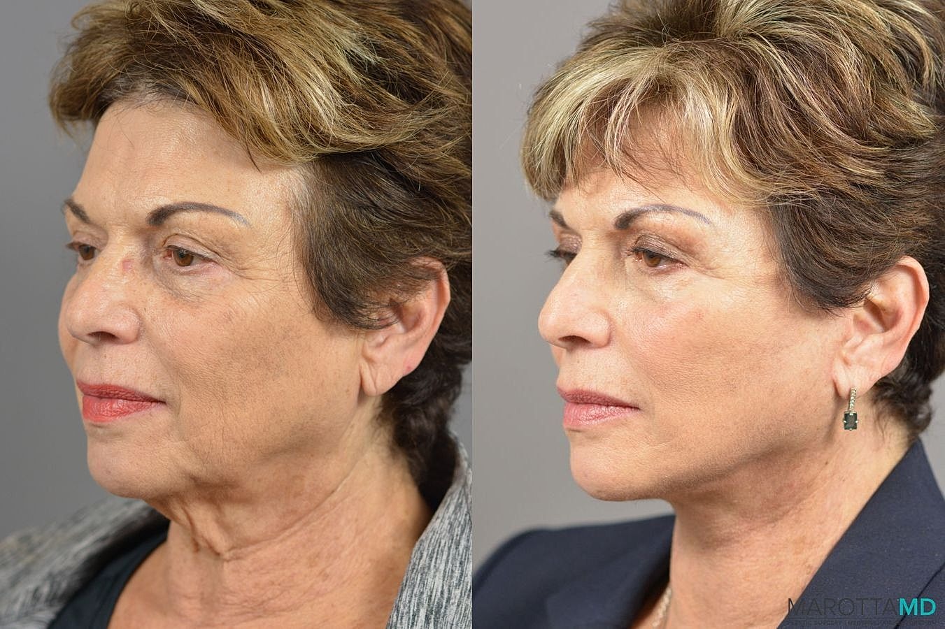 Facelift Neck Lift Before & After