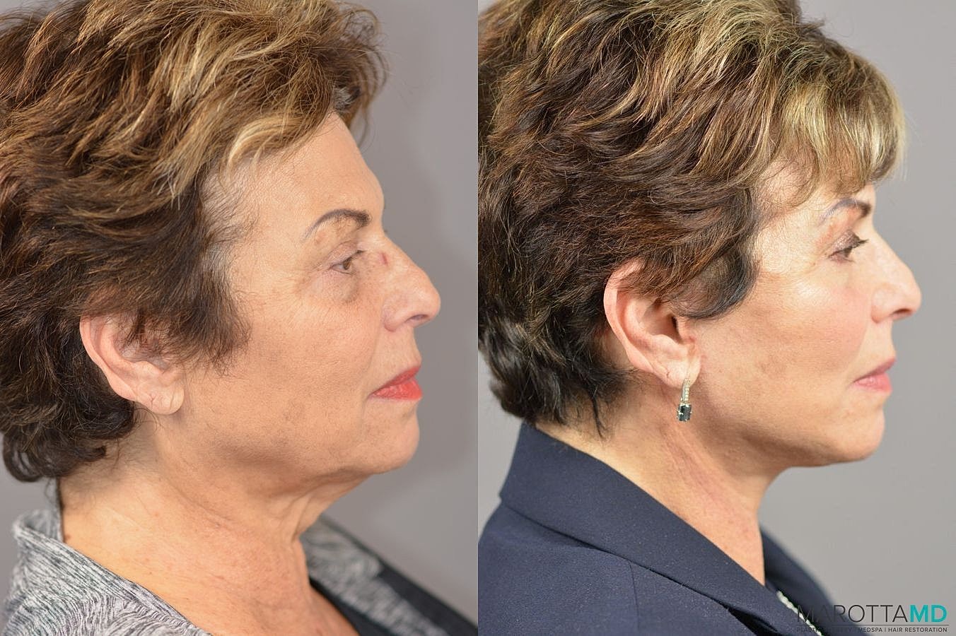 Facelift Neck Lift Before & After
