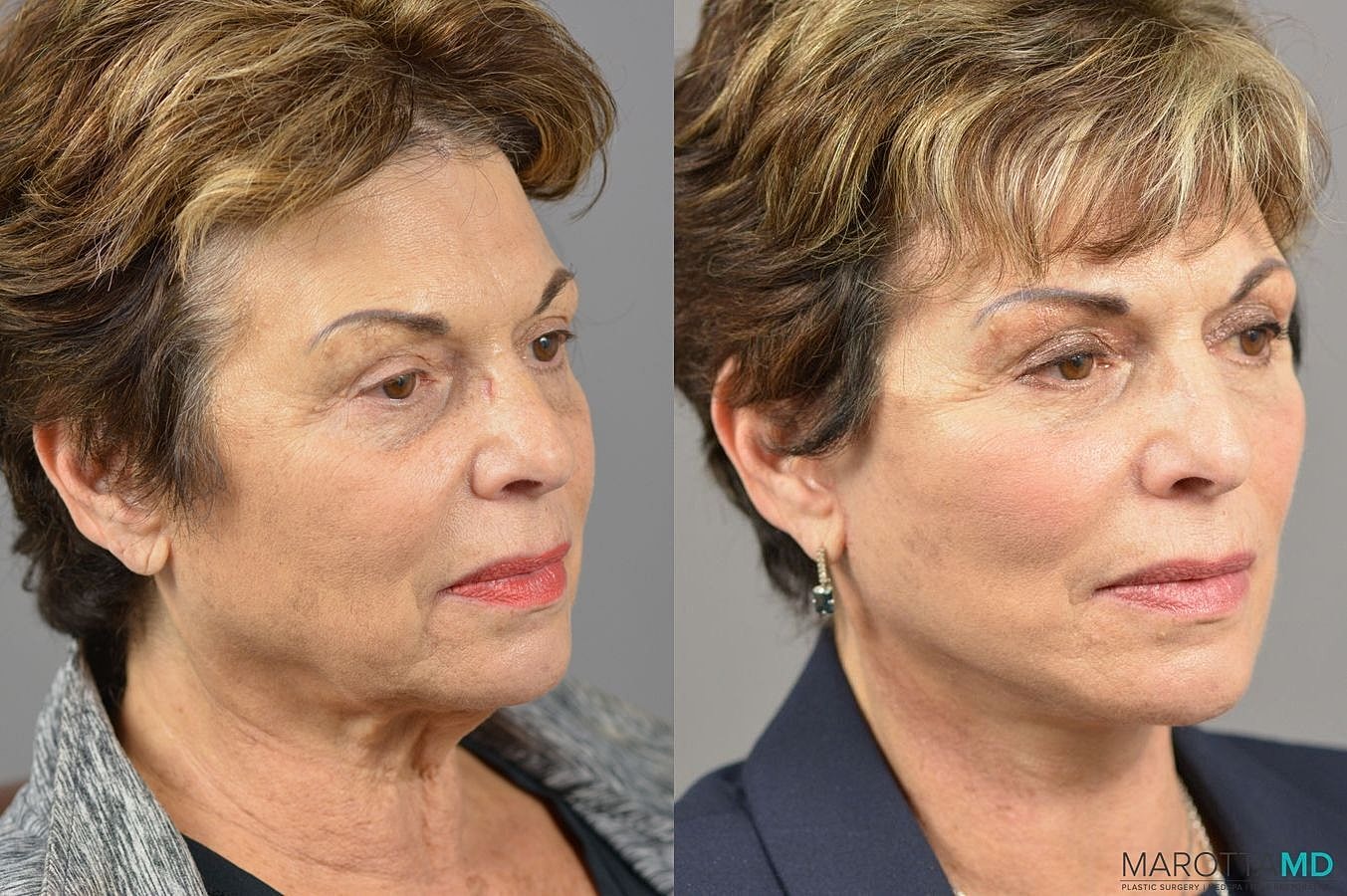 Facelift Neck Lift Before & After