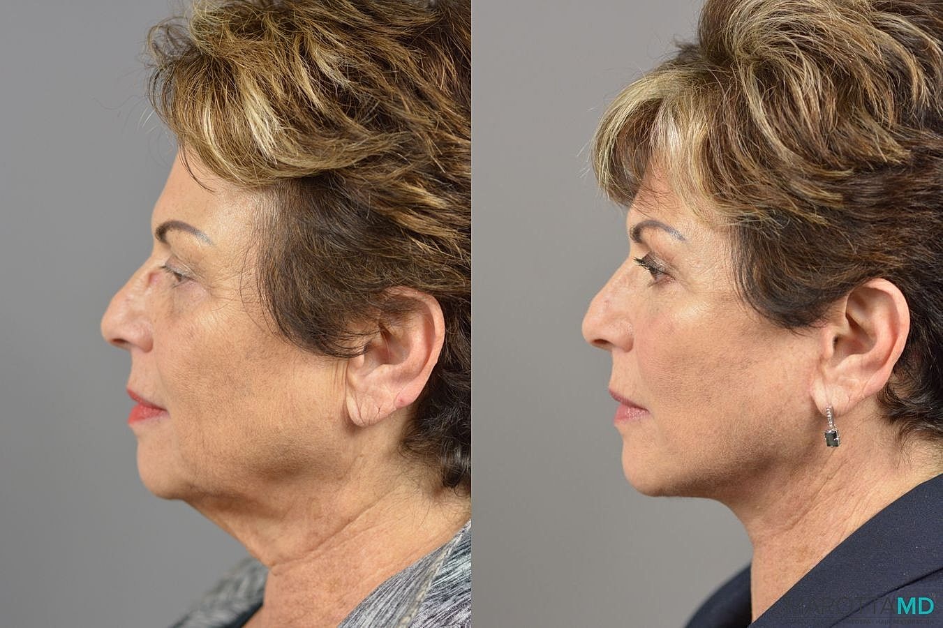 Facelift Neck Lift Before & After