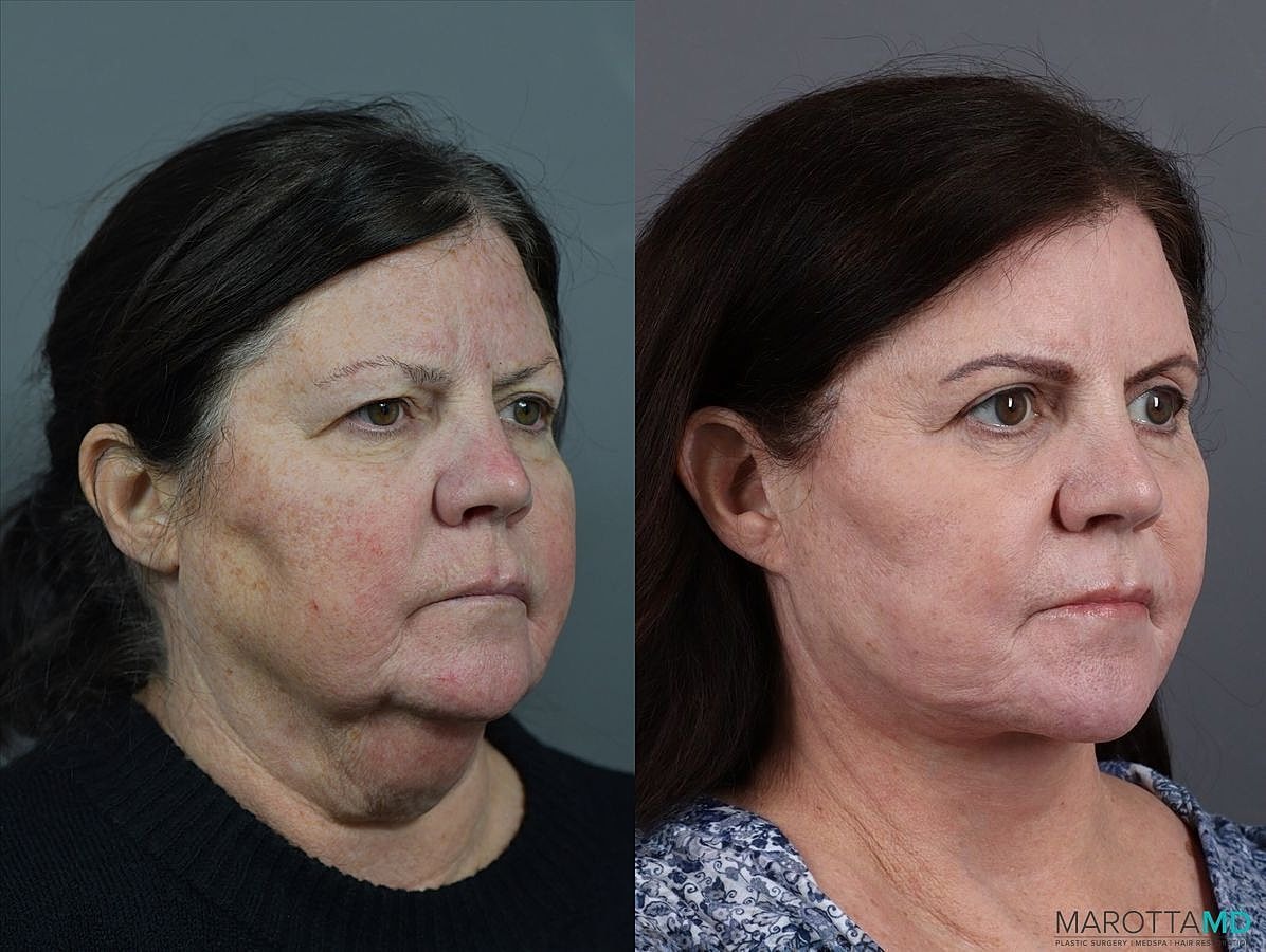 Facelift Neck Lift Before & After