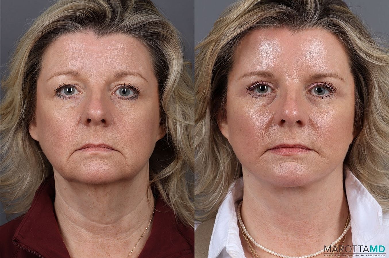 Facelift Neck Lift Before & After