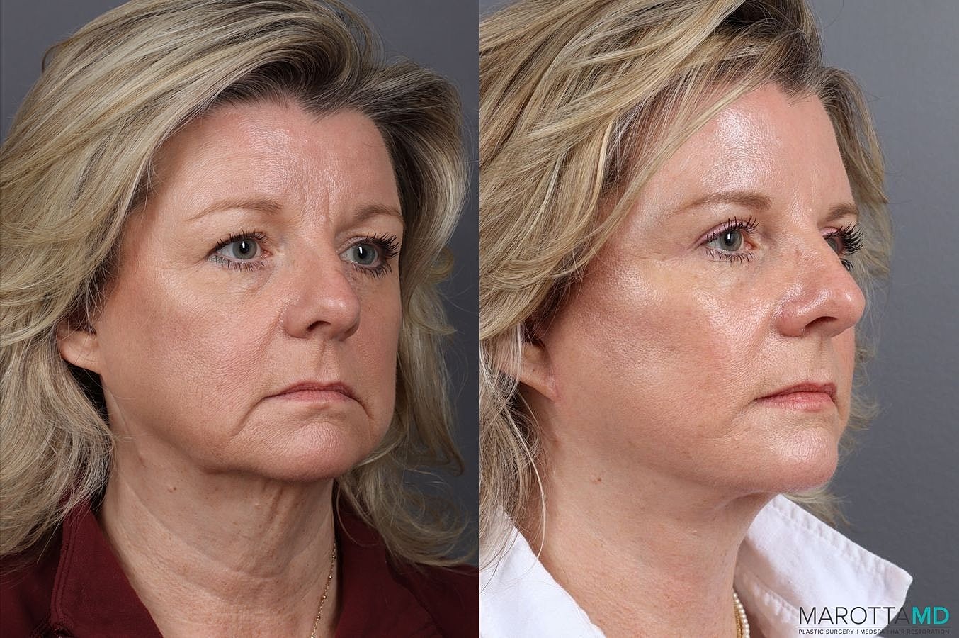 Facelift Neck Lift Before & After