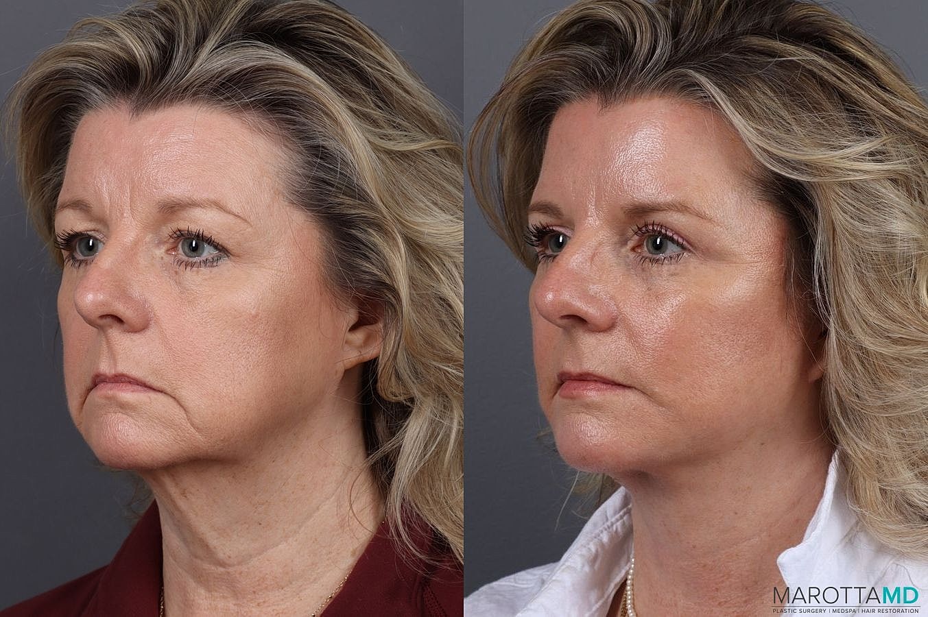 Facelift Neck Lift Before & After
